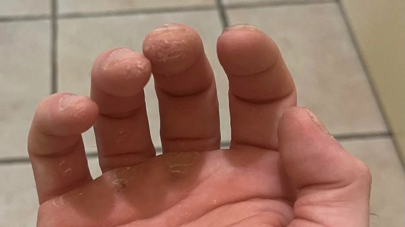 Bar Rot